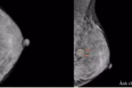 Sờ thấy ngực có khối bất thường, đi khám phát hiện u xơ tuyến vú
