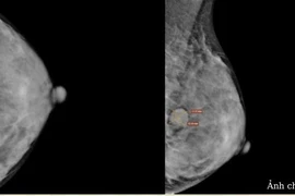 Sờ thấy ngực có khối bất thường, đi khám phát hiện u xơ tuyến vú