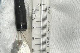 Gắp nắp lon nước ngọt trong dạ dày bé trai 11 tuổi 