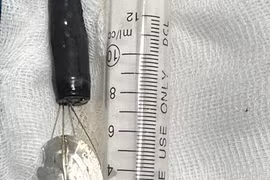 Gắp nắp lon nước ngọt trong dạ dày bé trai 11 tuổi 