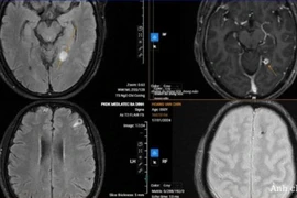 Sán chi chít làm tổ trong não vì... thói quen ăn đồ tái sống