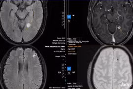 Sán chi chít làm tổ trong não vì... thói quen ăn đồ tái sống