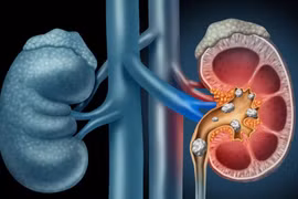 Sỏi thận có thể tự đào thải khỏi cơ thể không?