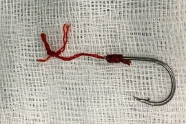 Dị vật móc câu cá cắm sâu vào hậu môn người đàn ông 40 tuổi
