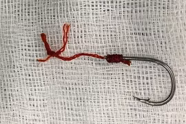 Dị vật móc câu cá cắm sâu vào hậu môn người đàn ông 40 tuổi