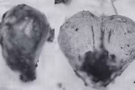 Nguyên nhân bất ngờ khiến người phụ nữ rong huyết nhiều năm