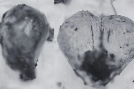 Nguyên nhân bất ngờ khiến người phụ nữ rong huyết nhiều năm