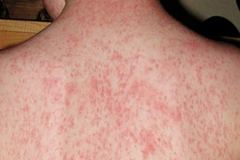 Bé gái 14 tuổi sốt cao, phát ban vì mắc bệnh truyền nhiễm