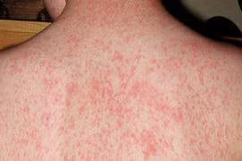 Bé gái 14 tuổi sốt cao, phát ban vì mắc bệnh truyền nhiễm