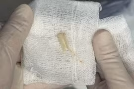 Thở ra tiếng kèn... phát hiện dị vật ở phế quản bé trai 7 tuổi 