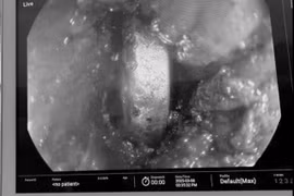 Bé 4 tuổi suýt thủng thực quản vì... pin đồ chơi