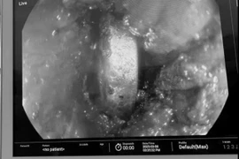 Bé 4 tuổi suýt thủng thực quản vì... pin đồ chơi