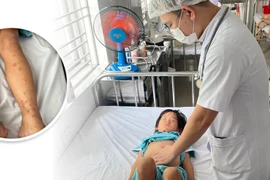 Cẩn trọng với bệnh viêm mao mạch dị ứng ở trẻ em