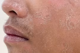 Nam thanh niên bị bỏng độ 2 vì ngủ quên khi tắm nắng