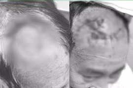 Người đàn ông bị khuyết hổng vùng trán do... chăm sóc vết thương không đúng cách