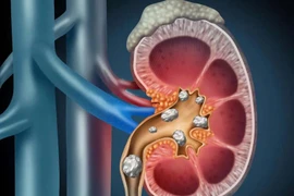 Bụng to dần, kèm đau hông lưng,... đi khám phát hiện thận sưng ứ nước tiểu