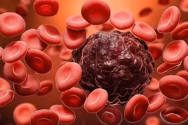 Hoa mắt, sút cân, đổ mồ hôi trộm về đêm... không ngờ mắc ung thư máu