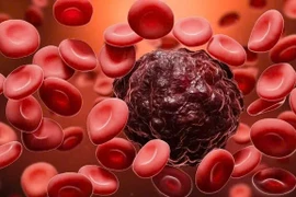 Hoa mắt, sút cân, đổ mồ hôi trộm về đêm... không ngờ mắc ung thư máu