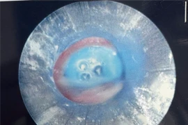 Ăn kẹo socola dạng bơm tiêm, bé trai bị sặc đầu ống vào đường thở