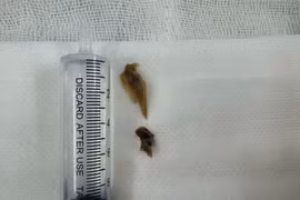 Xương vịt "trú ngụ" trong phổi bệnh nhân gần 2 năm