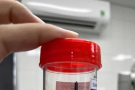 Mảnh gỗ "ngủ quên" trong hốc mắt nam thanh niên suốt 1 tháng