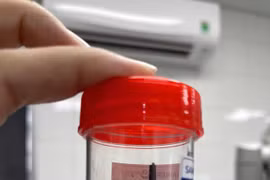 Mảnh gỗ "ngủ quên" trong hốc mắt nam thanh niên suốt 1 tháng