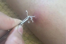 Mối nguy hiểm tiềm ẩn của bệnh giun rồng