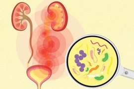 Không chủ quan với nhiễm khuẩn tiết niệu tái phát: Nguy cơ biến chứng thận