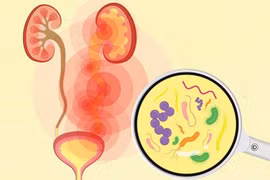 Không chủ quan với nhiễm khuẩn tiết niệu tái phát: Nguy cơ biến chứng thận
