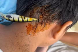 Đi câu cá, bé trai 11 tuổi bị lưỡi câu 5 cm ghim vào gáy