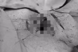 Nghẹt thở cứu sống nam thanh niên bị mảnh gỗ đâm xuyên cổ