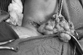 Phẫu thuật khối u mỡ "khổng lồ" cho bé 6 tháng tuổi