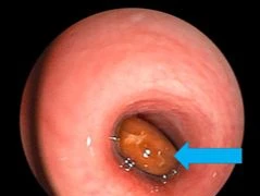 "Thủ phạm" khiến bé trai ho sặc sụa, khó thở, môi tái