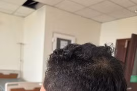 Thận trọng với biến chứng của viêm tai xương chũm mãn tính 