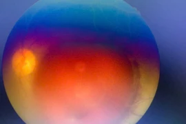 Tổn thương mắt do tia sáng laser trong đám cưới