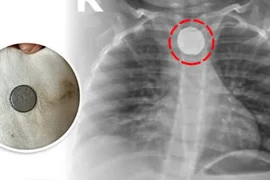 Dị vật pin cúc - hiểm họa khôn lường với trẻ em