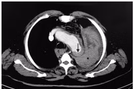 Một cú hắt hơi khiến nam Việt kiều... vỡ phình động mạch chủ