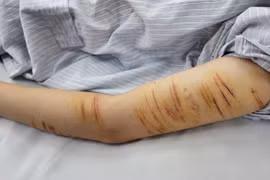 Nữ sinh 15 tuổi tự rạch tay để... giải tỏa stress