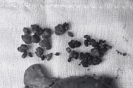 Mẩn ngứa suốt 2 năm, người phụ nữ bất ngờ phải cắt gan 