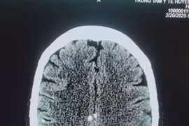 Chi chít sán từ chân tới não vì... sở thích ăn đồ sống