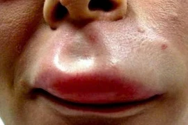 Sốc phản vệ do... tự ý điều trị đau lưng