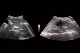 Bé trai 9 tuổi tổn thương thận do... lupus ban đỏ