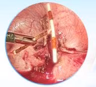 Người phụ nữ bị vòng tránh thai đâm thủng tử cung