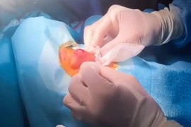 Tự nặn mụn nam thanh niên bị... viêm áp xe vùng mũi