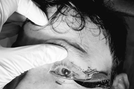 Đi câu cá, người đàn ông bị lưỡi câu móc vào nhãn cầu