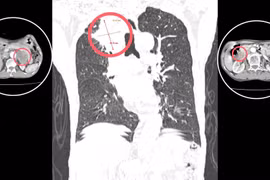 Phát hiện 3 khối u sau 30 năm không khám sức khỏe