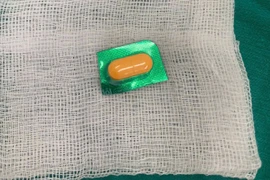 Viên thuốc còn nguyên vỏ sắc nhọn trong thực quản bệnh nhân 33 tuổi