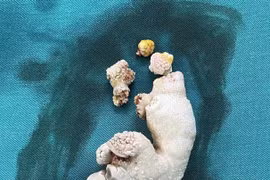 Sỏi san hô lấp đầy thận phải người phụ nữ 65 tuổi