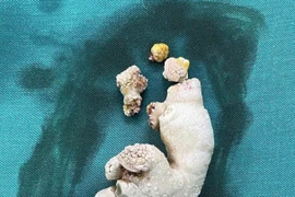 Sỏi san hô lấp đầy thận phải người phụ nữ 65 tuổi