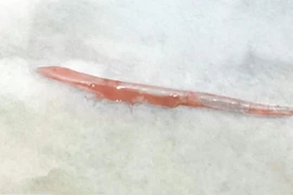 Người đàn ông bị xương cá dài cắm sâu vào lưỡi gây... tụ dịch nhiễm trùng